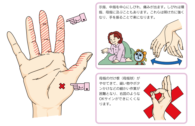 手根管症候群によるしびれと母指球筋の萎縮